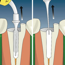 Safe Endo Calcicure Calcium Buy Dental products Online DentalMyntra